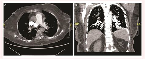 Figure 1 From Dialysis Catheter Related Sepsis Resulted In Infective Endocarditis Septic