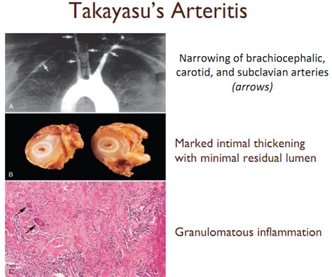 Large-Vessel Vasculitis - Arthritis Rheumatism