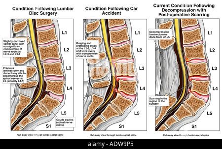 Lumbar Disc Herniation L With Surgical Laminectomy And Discectomy