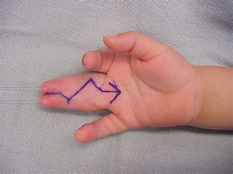 Birth Bilateral Complex Syndactyly Reconstructed In Three Stages