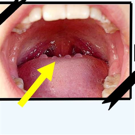 C Mo Quitar Llagas Del Fondo De La Lengua Enfermedades De La Lengua