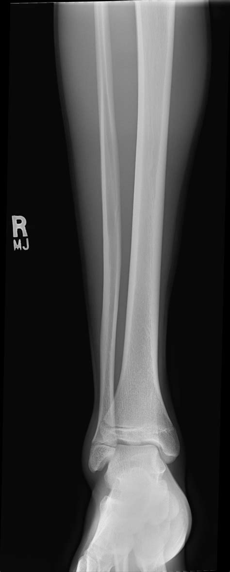 Triplane Fracture Radiology Case Radshare Net