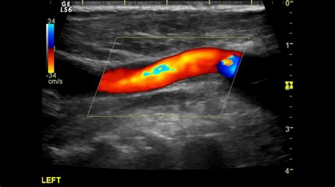 Carotid artery ultrasound - accountingkery