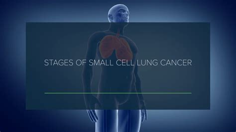 Stages of small cell lung cancer - Sharecare