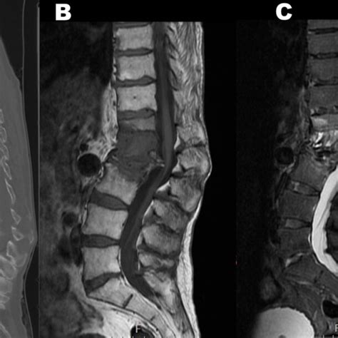 Pre Operative Ct And Mri Spine A Sagittal Ct Section Demonstrates