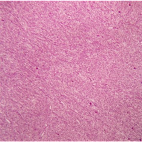 Shows A Neoplasm Composed Of Delicate Spindle Shaped Cells Arranged In