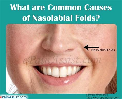 What Are Common Causes Of Nasolabial Folds Nasolabial Folds Mouth