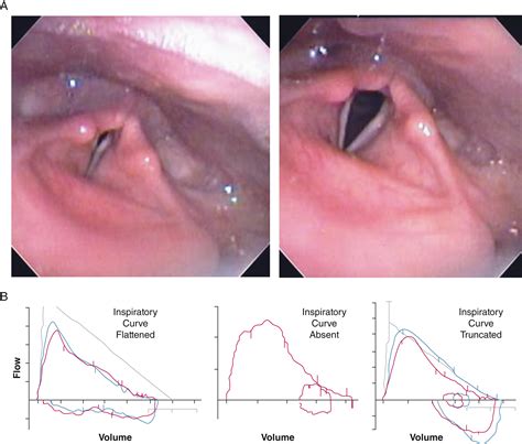 Laryngeal Dysfunction Manifesting As Chronic Refractory Cough And