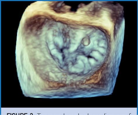 Figure From Robotic Assisted Resection Of Rare Mitral Valve