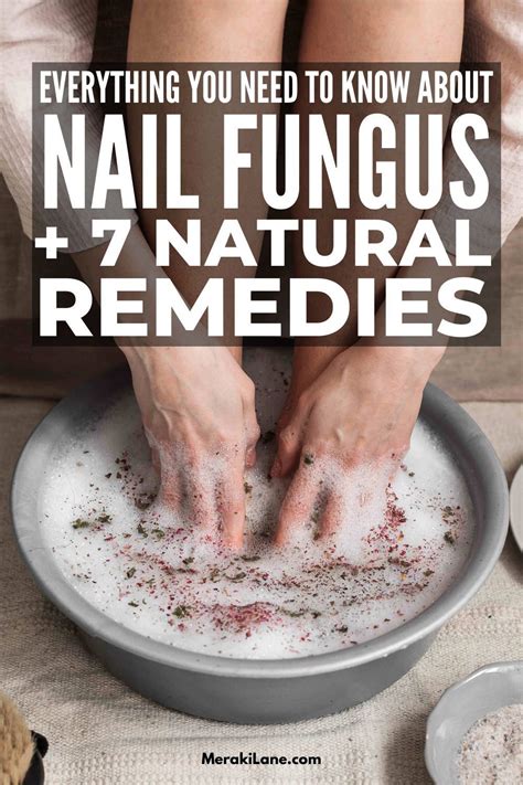 7 home remedies for nail fungus that work – Artofit