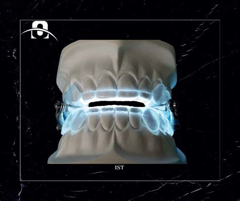 Obstructive Sleep Apnea Syndrom OSAS FN Orthodontics