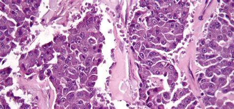 This Modified Common Cold Virus Specifically Targets & Kills Cancer