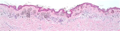 Junctional And Dermal Melanocytic Proliferation Composed Of Nests