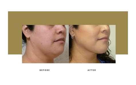 Liposuction Beverly Hills Julie Edween D O