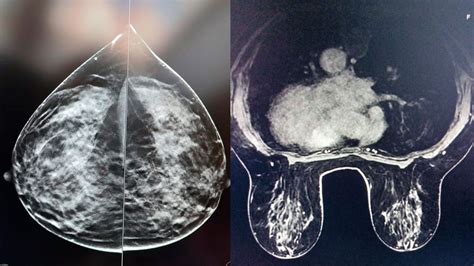 Diagnóstico Cáncer de Mama Origen Diagnóstico y traumatología