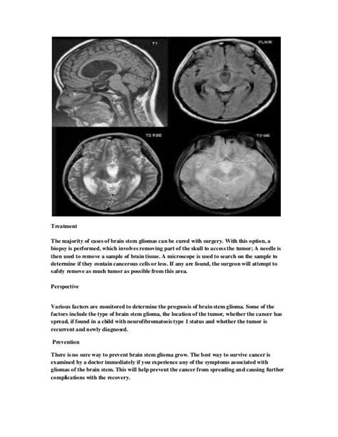 Brain stem glioma symptoms and treatment