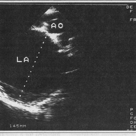 Two Dimensional Doppler Echocardiogram In Which A Massive Left Atrial