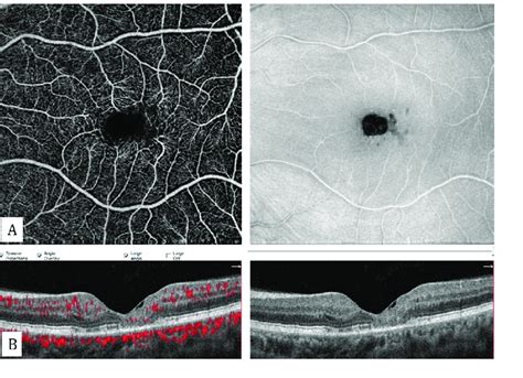 Idiopathic Macular Telangiectasia Type 2 A Enlargement And