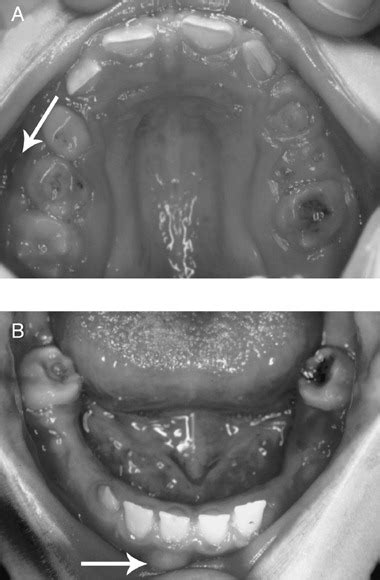 Intraoral photograph of the boy with severely hypoplastic yellowish ...