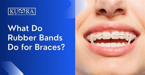 What Do Rubber Bands Do For Braces Kumra Orthodontics