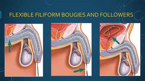 Urethral Strictures Ppt