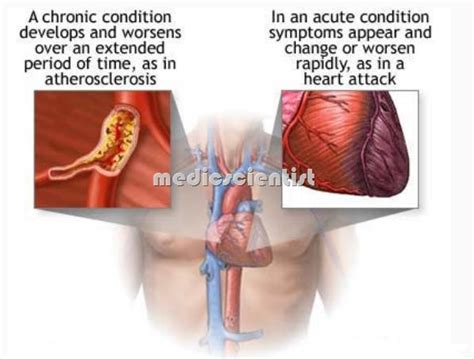 Cor pulmonale Causes of Cor pulmonale Symptoms of COR PULMONALE and ...