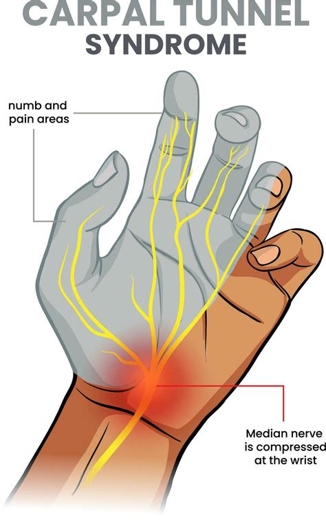 Illustration Of Carpal Tunnel Syndrome 24318127 Vector Art At Vecteezy