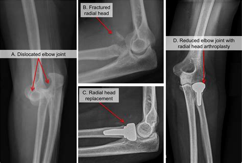 Posterior Elbow Dislocation