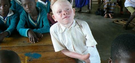 Thando Hopa Primera Modelo Albina Y Activista Sudafricana