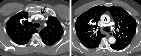 -A 62-year-old male with a circumaortic left brachiocephalic vein, CT... | Download Scientific ...