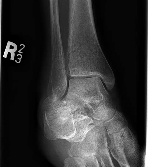 Ankle Fracture The Bone School