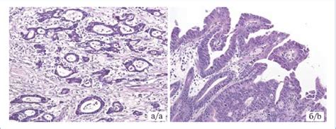 Tubular And Papillary Gastric Adenocarcinomas A Tubular Gastric