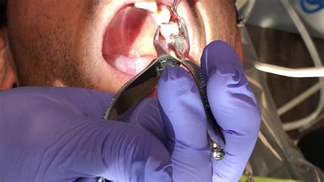 Tooth Extraction Root Tip Breaks Youtube