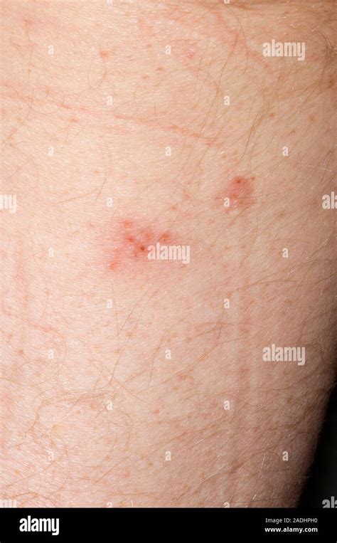 Shingles Rash On The Leg Of A 63 Year Old Man Shingles Is A Disease