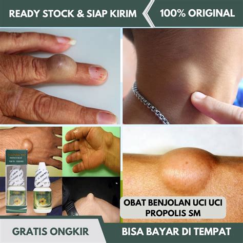 Jual Obat Benjolan Uci Uci Obat Benjolan Lipom Benjolan Lemak Obat