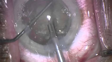 Cataract Surgery With Catalys Precision Laser System Youtube