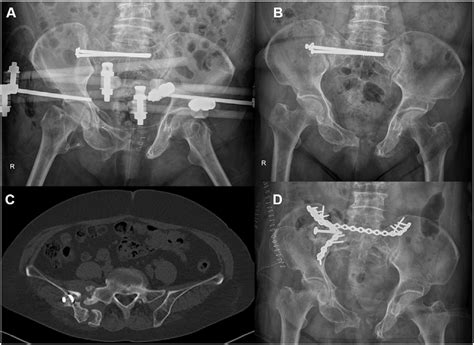 A A Supra Acetabular External Fixator Was Inserted To Stabilize The