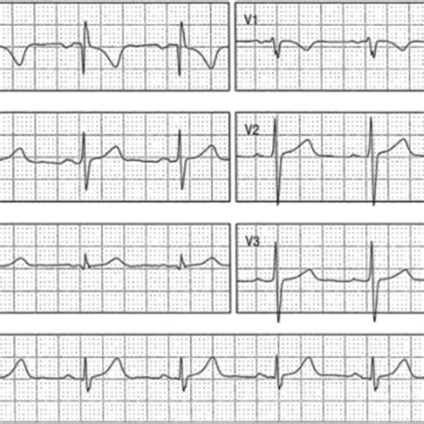 12 lead electrocardiogram in sinus rhythm. Normal sinus P waves, normal ...