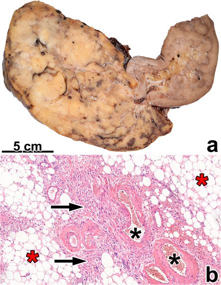 Renal Angiomyolipoma Gross