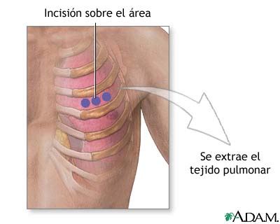 Medlineplus Enciclopedia M Dica Incisi N Para Biopsia De Pulm N