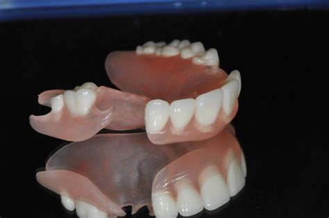 Flexible partial denture upper front teeth | Hummingbird Dental | Voted ...