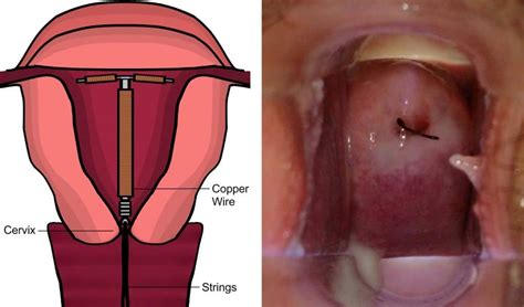 Contraceptive Iud