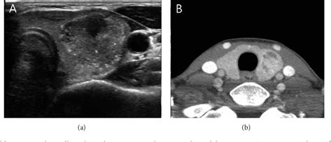 Table 1 From Prediction Of Extrathyroidal Extension Using Ultrasonography And Computed