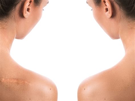 Keloid Scars Removal Treatment