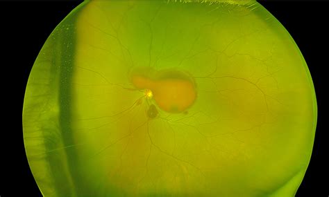 Blog Valsalva Retinopathy - Prime Retina Eye Care Centre - Best Eye ...