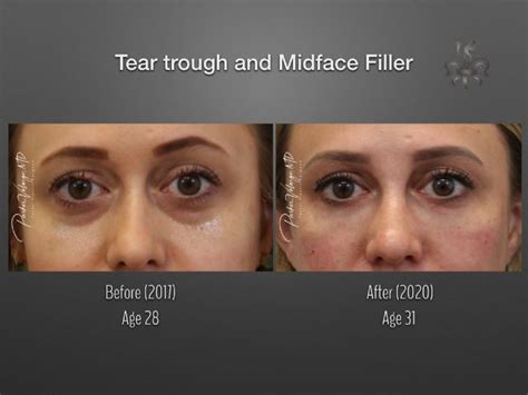 Dermal Fillers Case 4818 New Orleans Premier Center For Aesthetics And Plastic Surgery