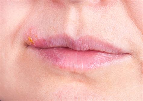 Las 5 Etapas De Un Herpes Labial Que Debes Conocer El Diario Ny