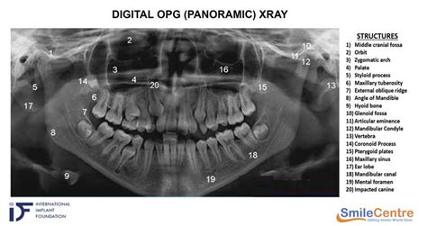 Dental Imaging Faciliy What Is Opg X Ray Smile Centre India