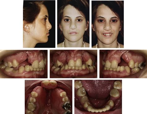 Progress facial and intraoral photographs before alveolar bone graft ...