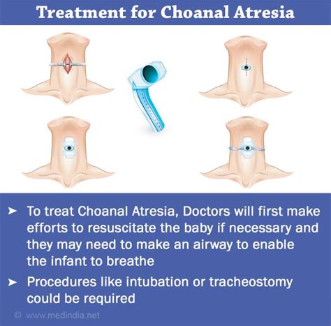 Choanal Atresia Causes Symptoms Diagnosis Treatment And Prevention